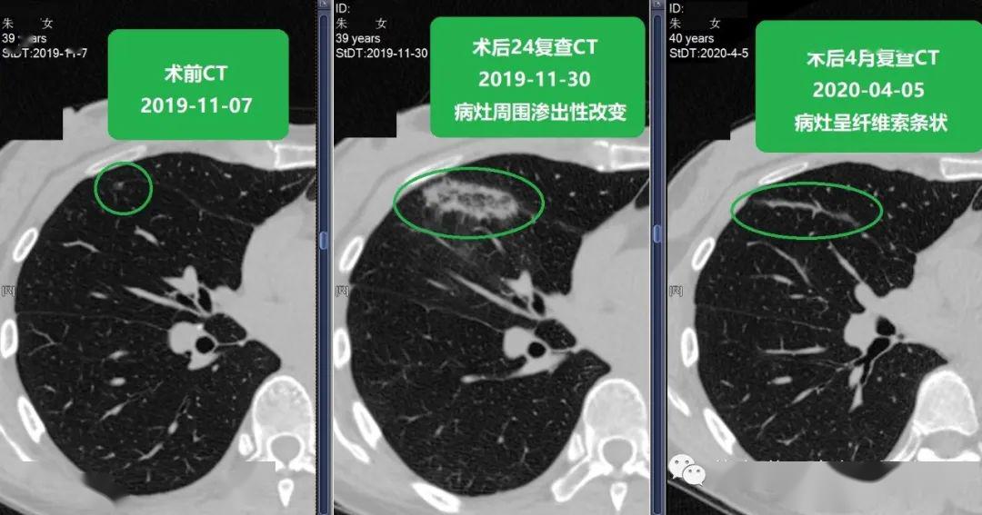 靳勇手術醫生2019-11-7行ct示右肺中葉一枚磨玻璃結節,長徑均約6mm,於