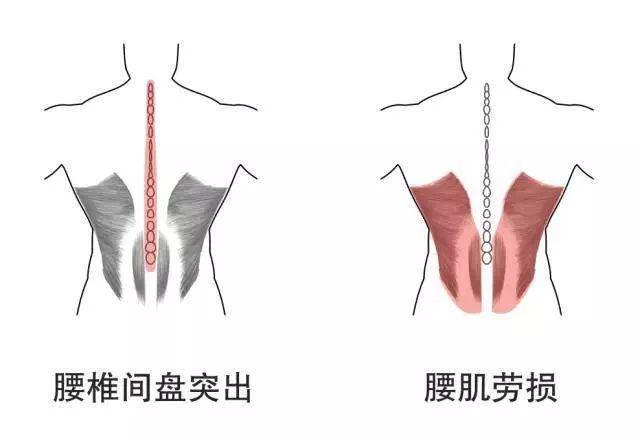 健康骨科丨腰椎間盤突出還是腰肌勞損3個自我鑑別的方法