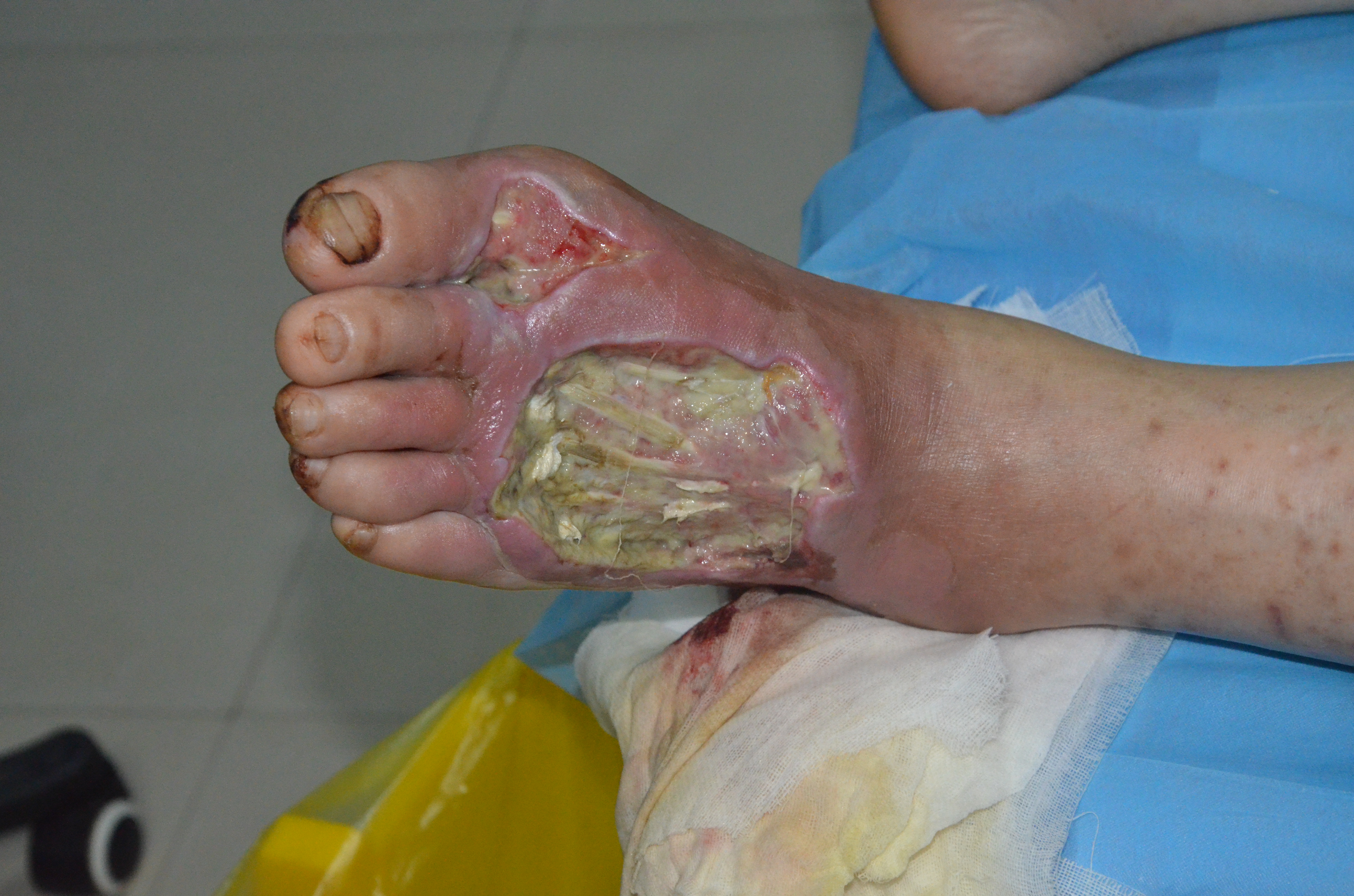 脚上的疾病有哪些图片图片