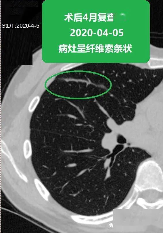 苏大附二院靳勇医生团队病例分享第51期肺磨玻璃结节的消融