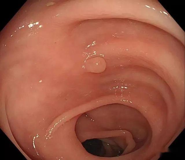 十二指肠降部息肉图片