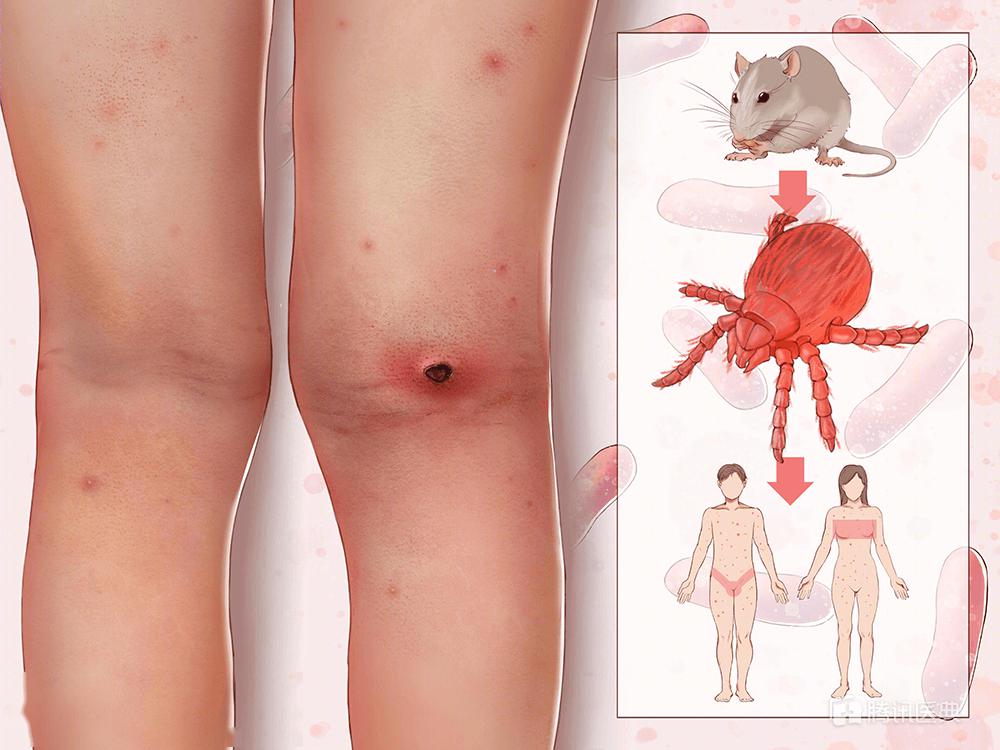 大量不明小黑虫侵扰深圳人,穿这颜色衣服要留心_恙虫