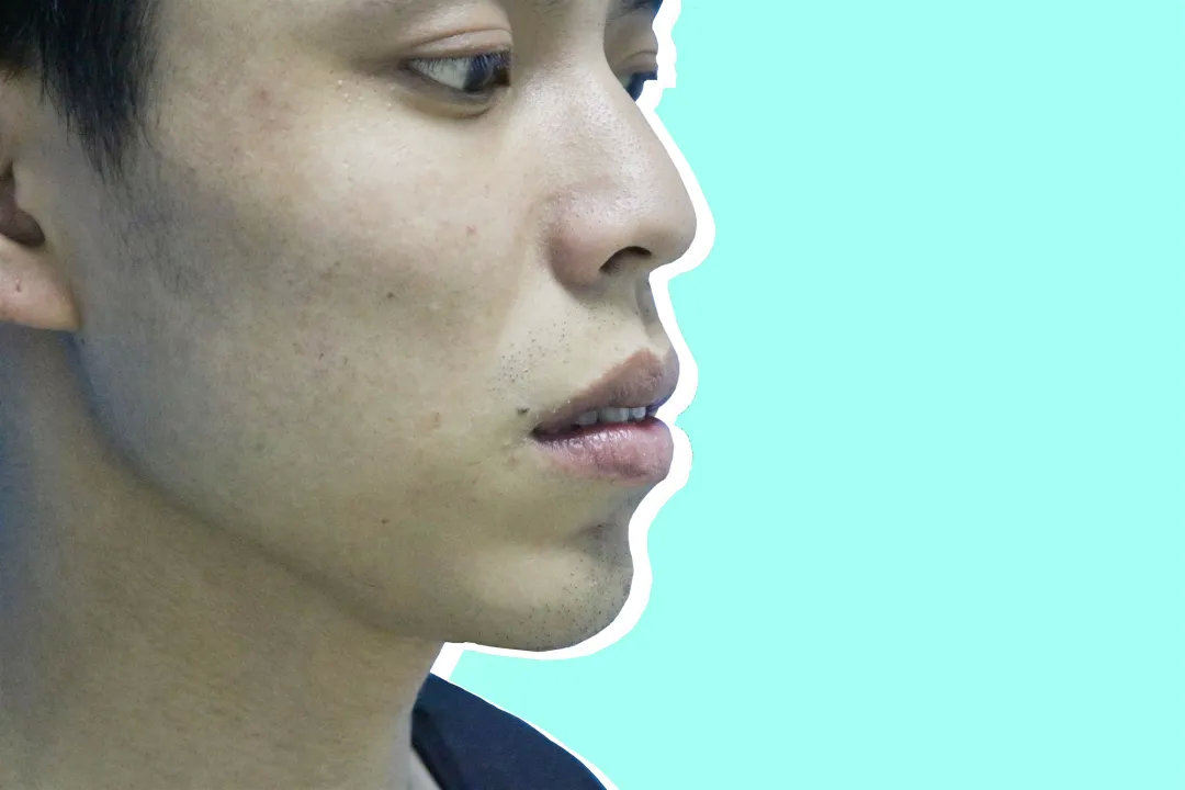 30岁有必要做正颌吗花钱做正颌值不值得让他告诉你答案