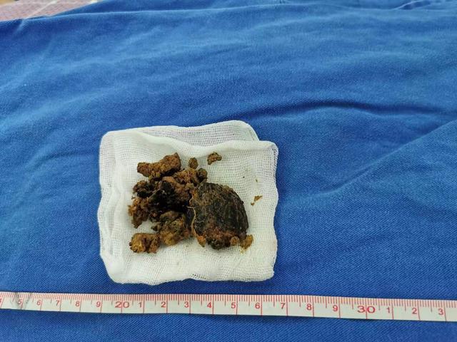 胃柿石 来自搜狐网