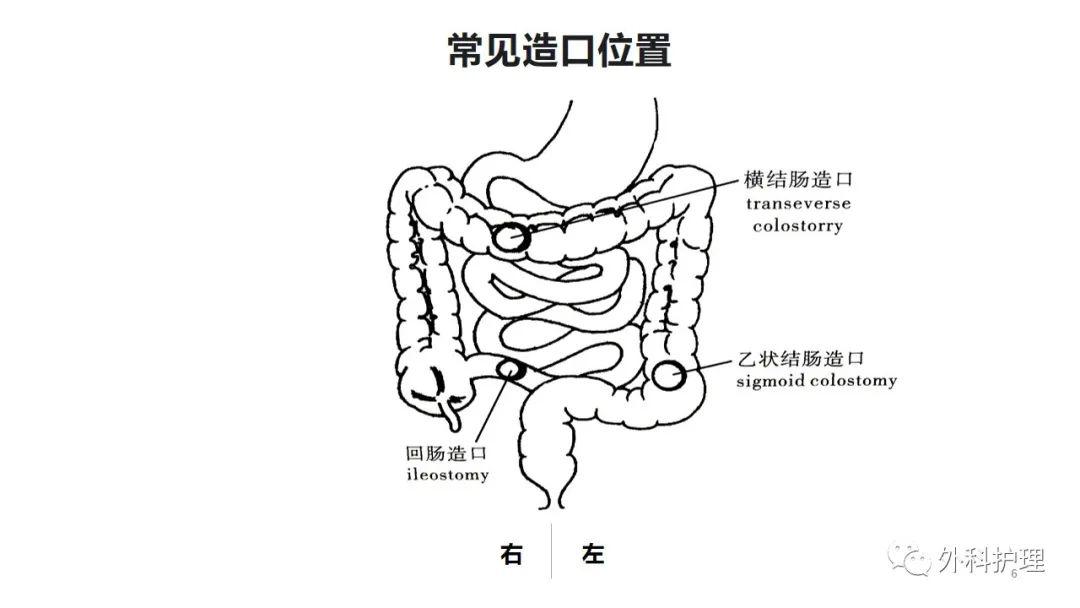 乙状结肠造口位置图片