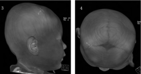 立即将患儿送至放射科行头颅多层螺旋ct容积扫描加三维重建,ct 骨三维