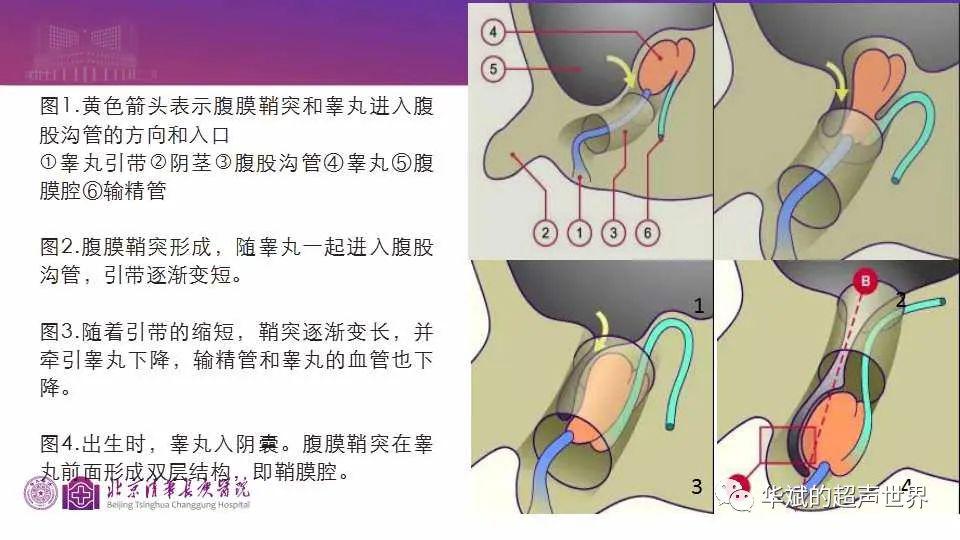 鞘膜突图片