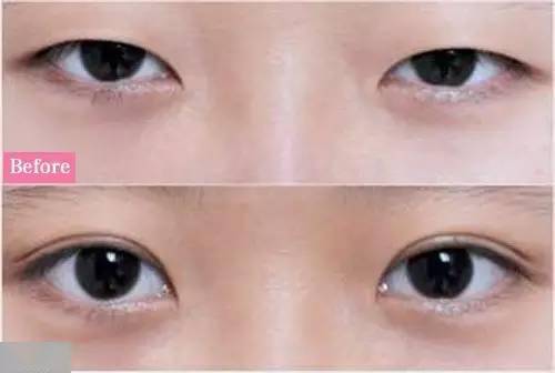 眼睛睁不开/上睑下垂