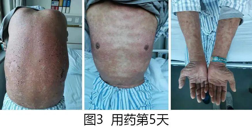 肿瘤患者请注意抗癌药物致皮疹惨中医再创小绝招棒省中自研皮炎宁方