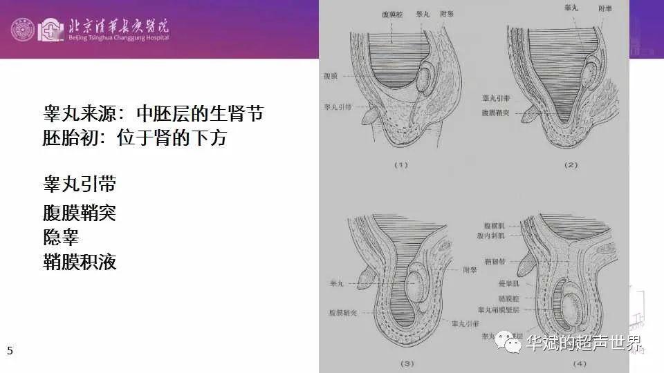 腹膜鞘状突位置图片图片