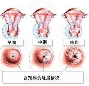 兖州区中医医院关爱女性健康 助力宫颈癌筛查优惠活动