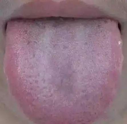 舌头一旦出现这个信号马上去医院
