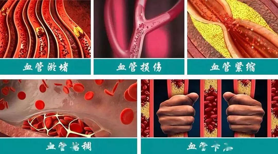 复杂,但归根结底主要表现为血液粘稠问题,血管紧缩,血管损伤,血管淤堵