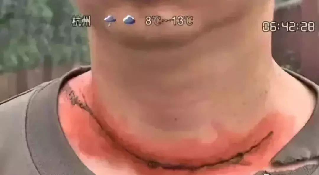 惨剧一对夫妻为孩子高压线上摘风筝双双受电击被截肢提醒大家风筝也