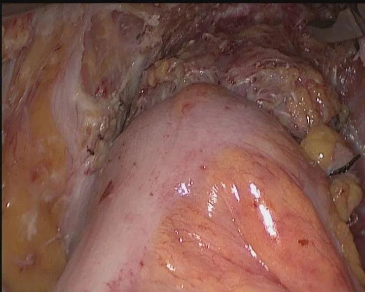 渭南市第二医院肿瘤胸外科成功开展首例腹部无切口腔镜直肠癌根治术
