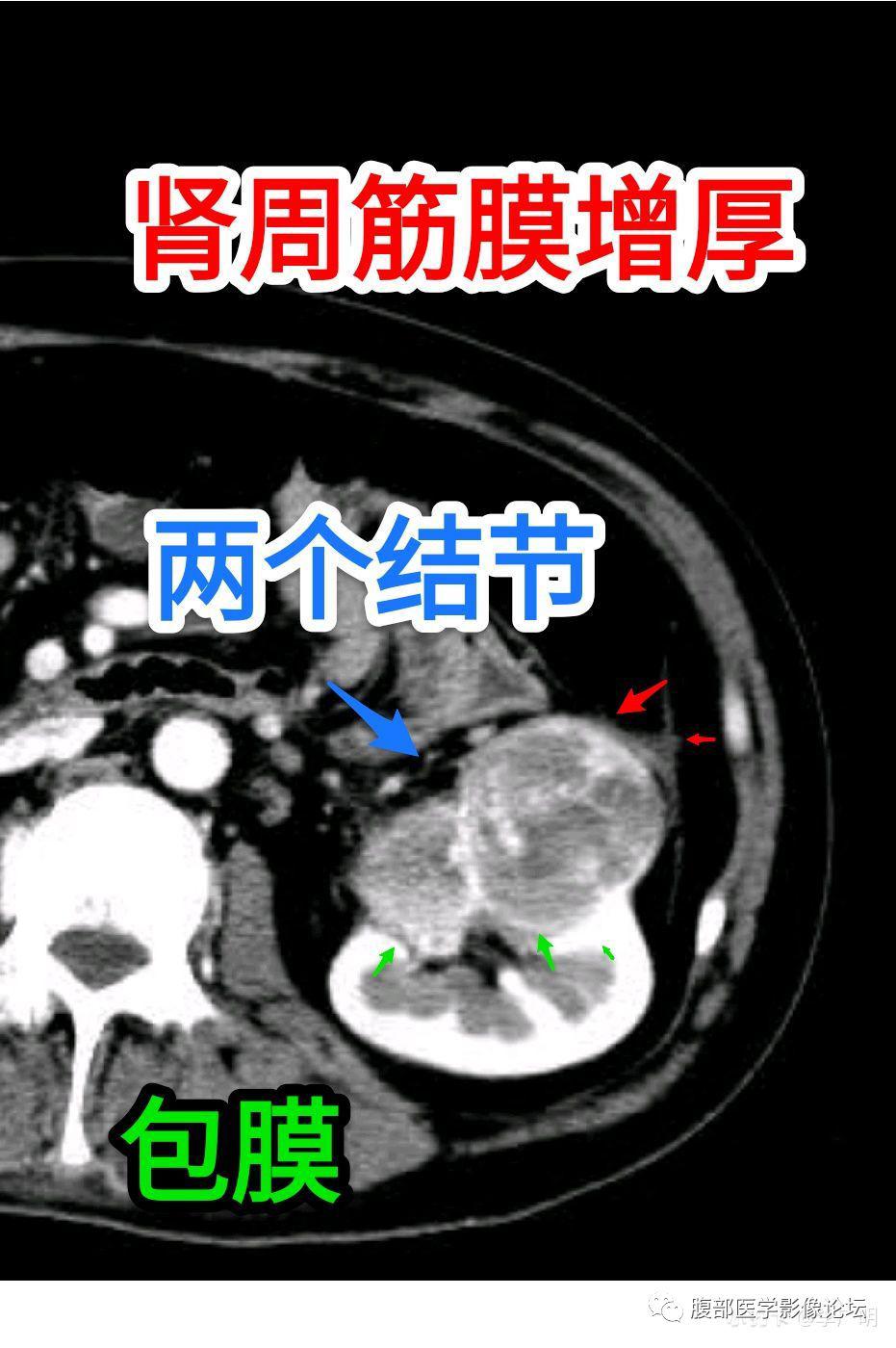 李廣明:左腎兩個結節融合腫塊,平掃密度高低不均,有包膜,有鈣化,中心