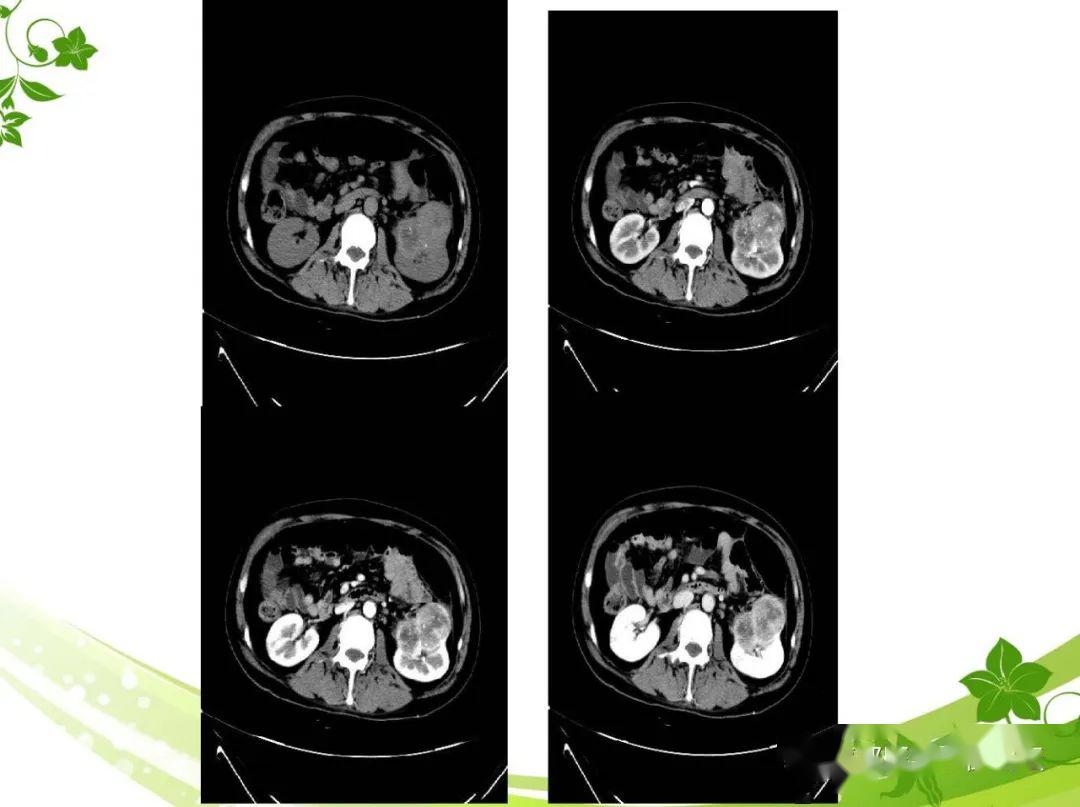 腎臟丨左腎透明細胞癌