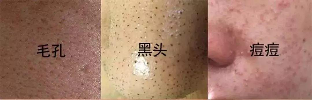 拒绝螨虫脸5秒揉一揉螨虫全出来了痘痘黑头全没了