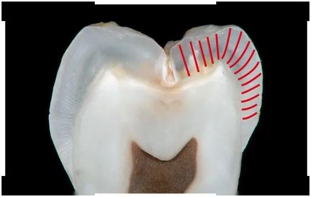1)前牙预备洞缘短斜面:短斜面常规宽度为2mm,角度45°,预备成弧线避免