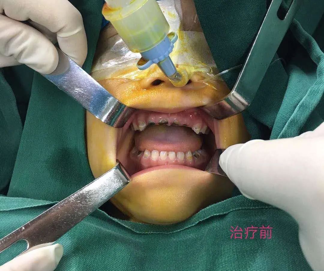 精湛的麻醉技术 让孩子不再恐惧牙科手术