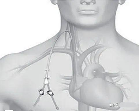 颈动静脉瘘图片
