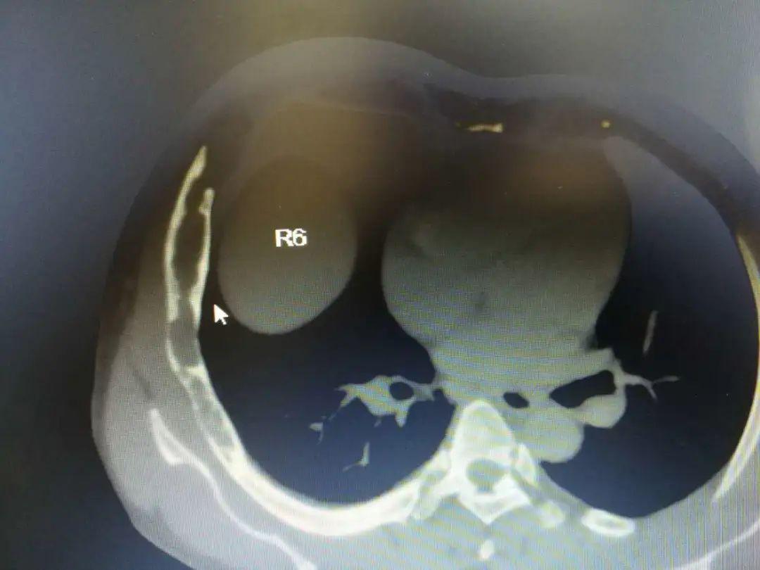 肋骨肿瘤图片图片