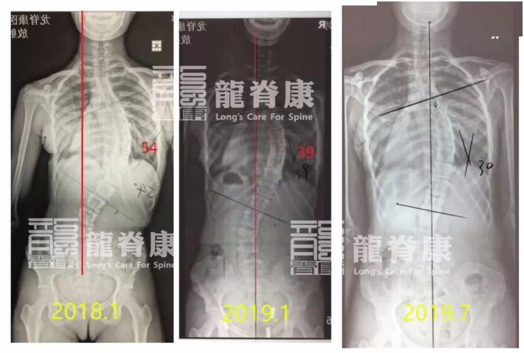大角度脊柱侧弯孩子成功避免手术,剃刀背从20°减至5°!_徐天明