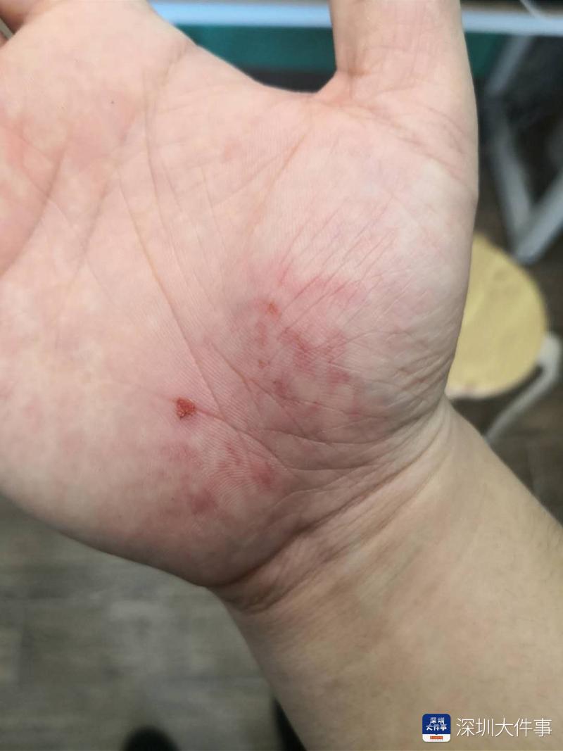 深圳男子骑行被树枝砸伤车轮砸变形绿道养护公司赔1500元