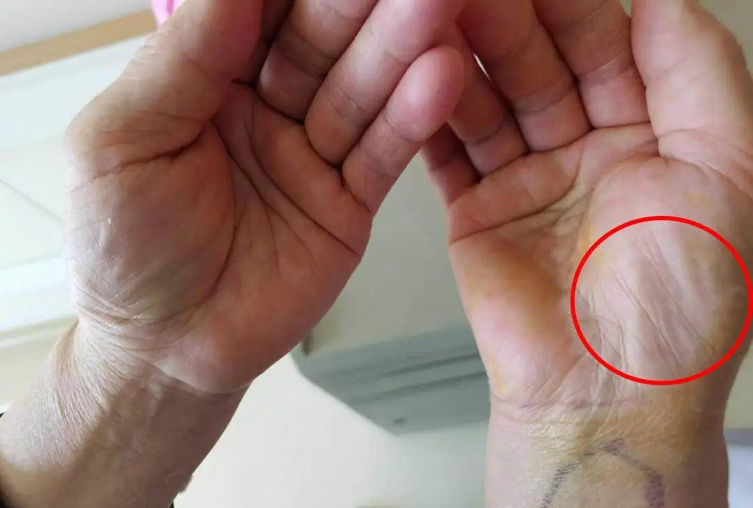 女子因拖延就医麻了一年的手瘪了年轻人都容易中招