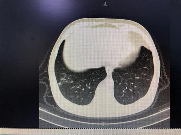 兩肺上葉及右肺下葉可見斑片狀高密度影,邊緣模糊;兩肺少量支氣管擴張