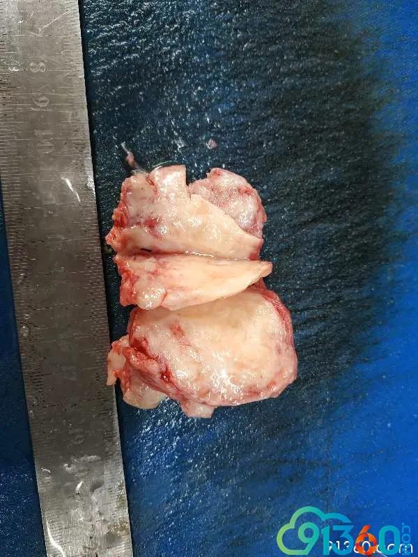 病理沙龙子宫肌壁间肿物平滑肌瘤