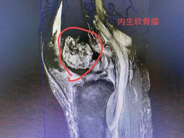 膝盖肿瘤图片大全图片