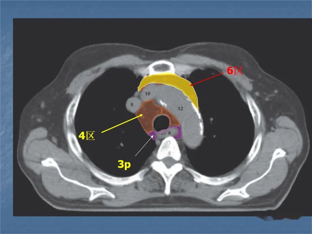 胸部淋巴结分组