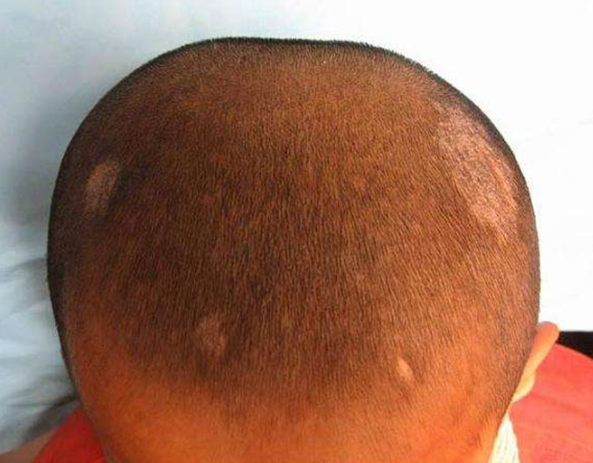 怀来卫十肤之头癣