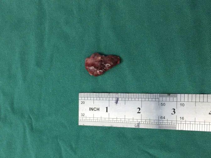 腰骶部疼痛数月,我院骨科显微镜下捉"元凶"_肿瘤