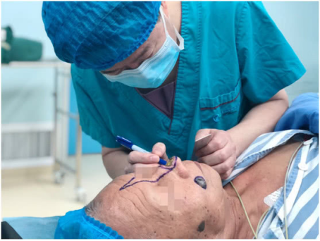 老人鼻子烂了一个洞重庆仁品为其再造新鼻