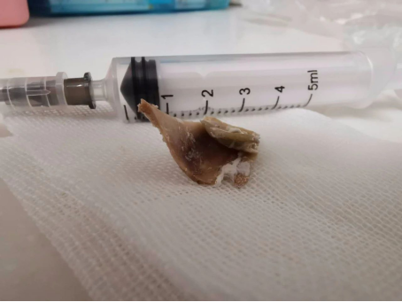 喉咙卡异物怎么办,重庆仁品耳鼻喉医院5分钟取出咽喉异物