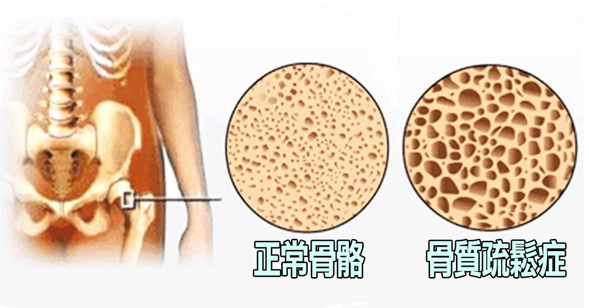 给口重的人提个醒你可能已经在骨质疏松的边缘了