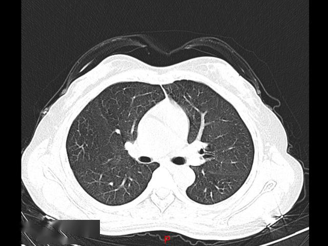 警惕!两女子肺部ct全是白色,只因天天在家做这件事