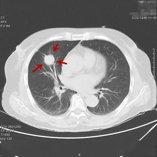 零功底也能看各种类型肺癌典型表现