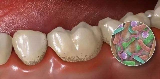【蛀牙】蛀牙的危害_蛀牙怎么办_蛀牙痛怎么快速止痛