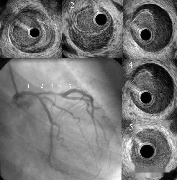 市中医医院介入治疗水平勇攀高峰成功开展首例血管内超声指导下复杂