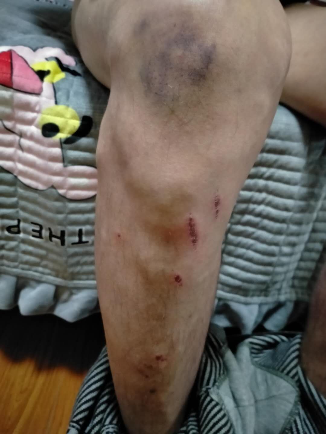 山西榆次君豪商场电梯突发故障致花甲老人摔成骨折多处受伤