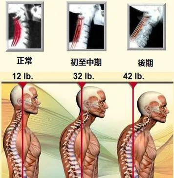 儿童脖子前倾图片