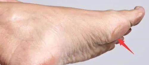 呈现出的症状就是使皮肤,巩膜,黏膜发生黄染的现象,这时脚底就会发黄