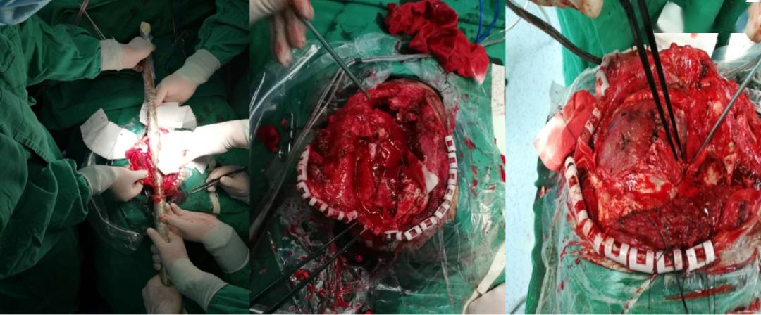 新医神外双周刊第四期一例钢管穿通致重型颅脑颌面眶多发伤的处理