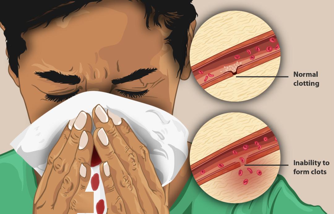 血友病常被误认为白血病如今已非不治之症但仍需要你的关注