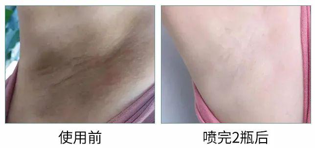 看完这一波真实的使用反馈,我相信我的狐臭有救了!_分泌物