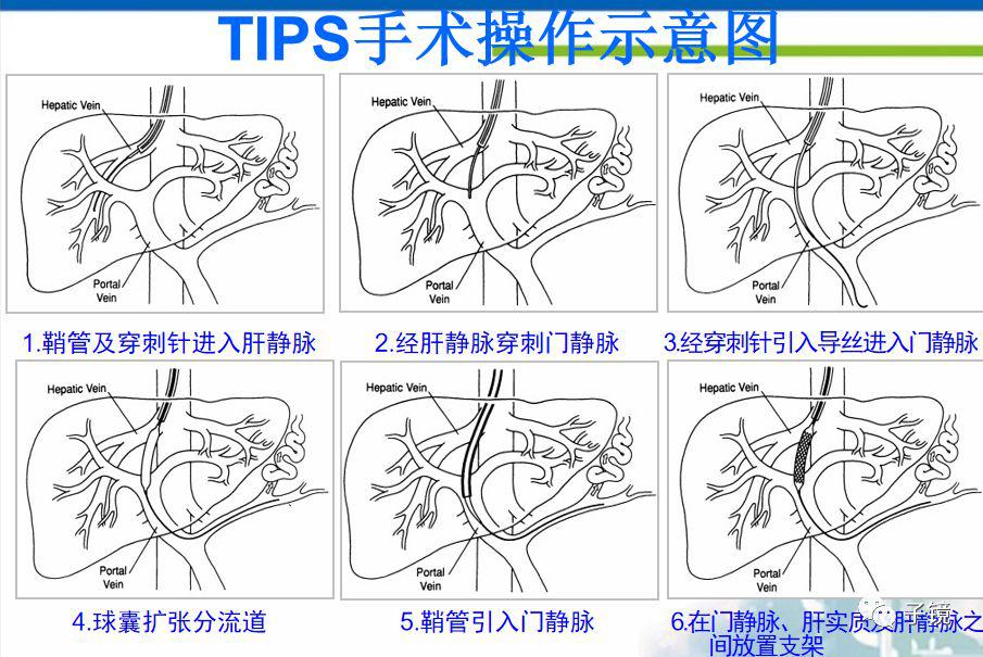 tips手术步骤的图片图片