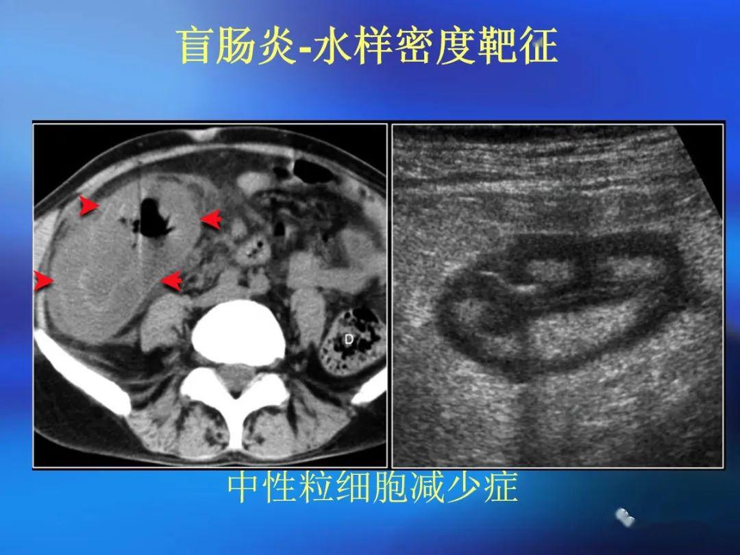 腸道壁增厚ct表現